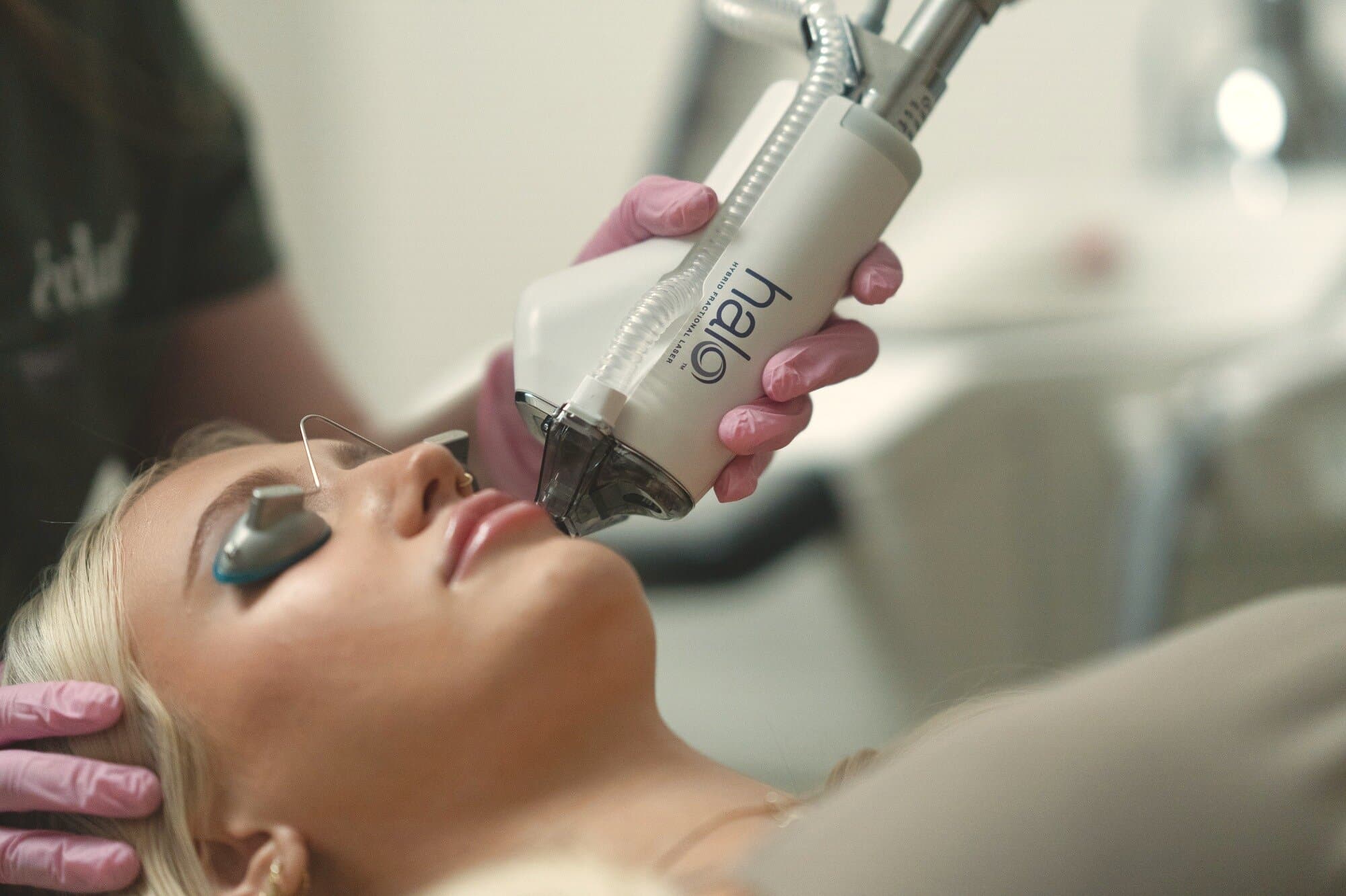 HALO® hybrid fractional laser resurfacing (Sciton)